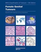 Female Genital Tumours